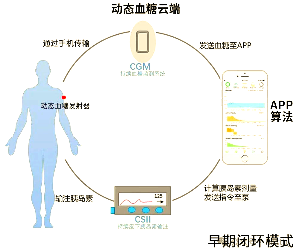 美敦力780g 革命性的闭环式胰岛素泵，引领高效、稳定与精确的糖尿病管理